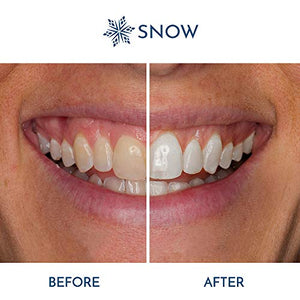 SNOW Teeth Whitening Kit with LED Light, Complete at-Home Whitening System, LED Teeth Whitening Kit with 4 Whitening Wands, LED Mouthpiece, Shade Guide, Teeth Whitener System
